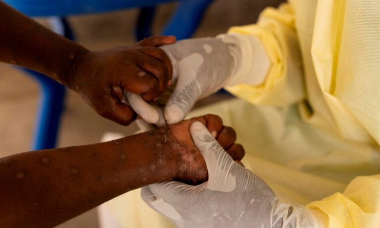 África registra 4 mil nuevos casos de la viruela del mono