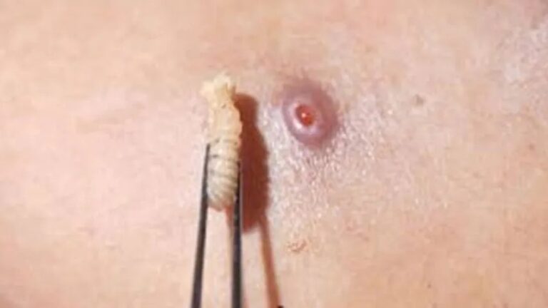 Nicaragua registra dos casos de gusano barrenador en humanos