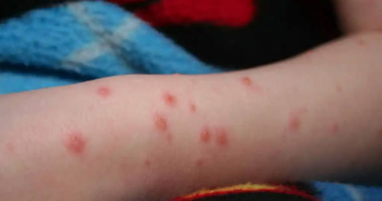 México registra 3,145 casos de viruela del mono