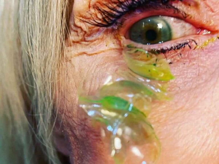 Acude al médico por un dolor y le extraen del ojo 23 lentes de contacto