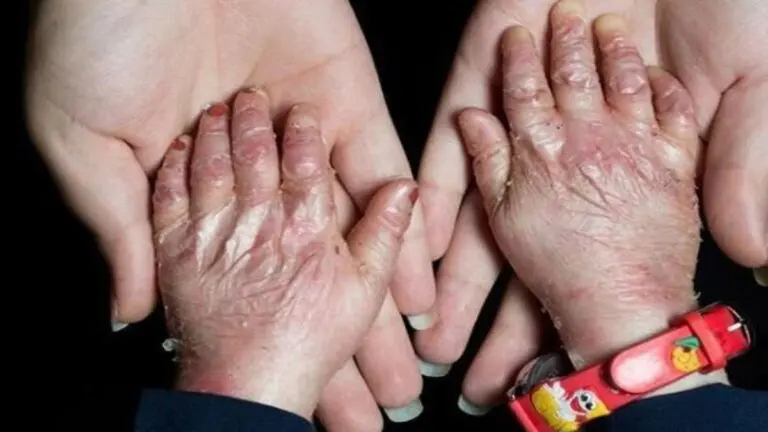 Irán exige a EE.UU. indemnizar a pacientes con epidermólisis ampollar