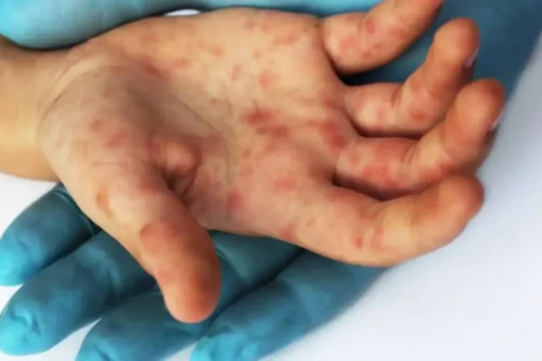 Realizan estudios para determinar propagación de viruela del mono